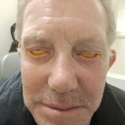 Por mala cirugía estética, hombre pasa tres años sin cerrar los ojos